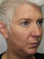 Facelift/Necklift