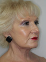 Facelift/Necklift