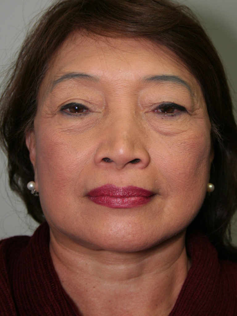 Facelift/Necklift