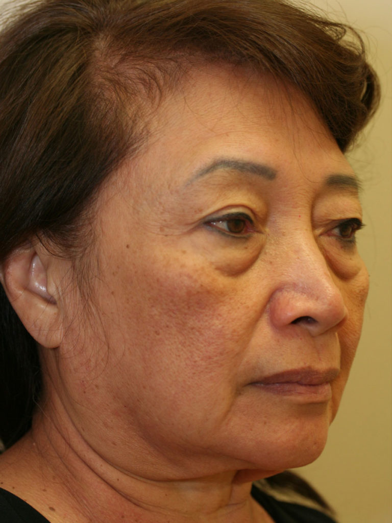 Facelift/Necklift