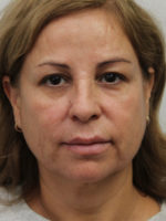 Facelift/Necklift