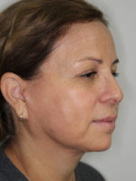 Facelift/Necklift