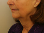 Facelift/Necklift