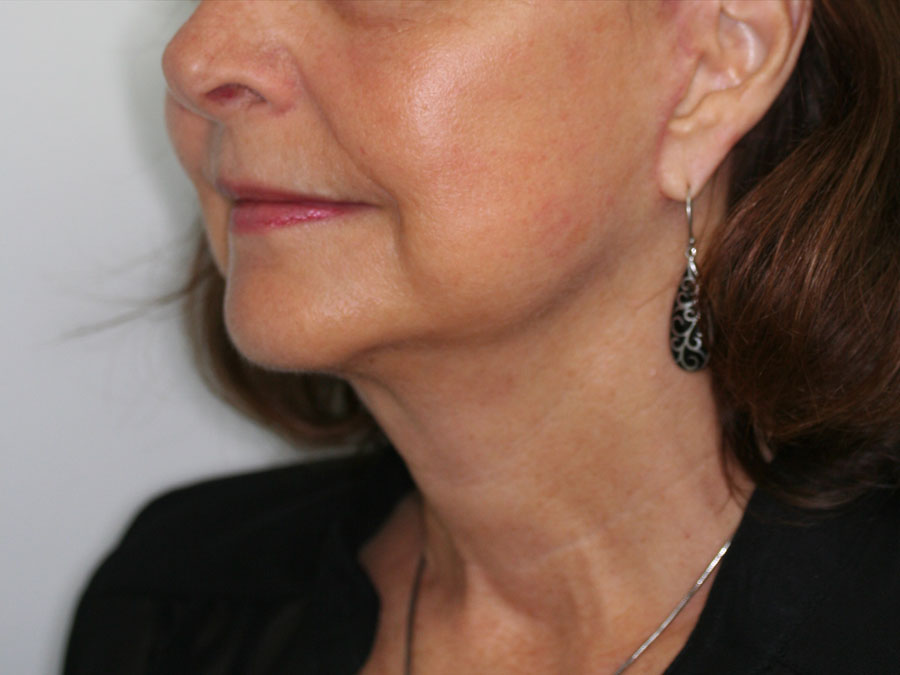 Facelift/Necklift