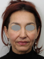 Facelift/Necklift