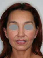 Facelift/Necklift