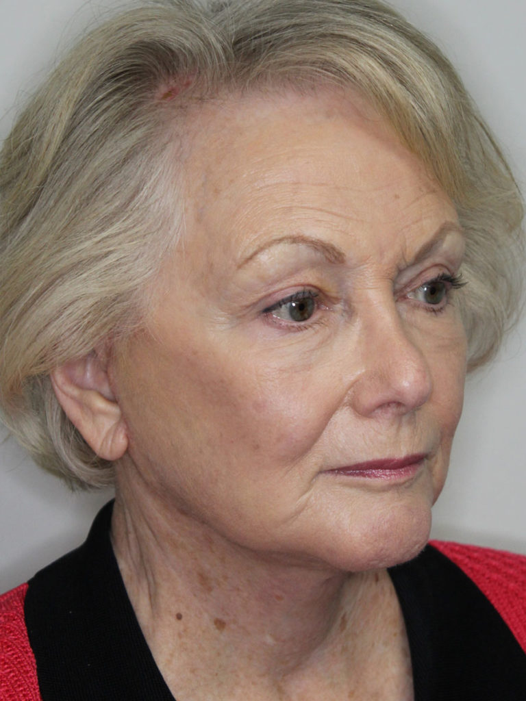 Facelift/Necklift