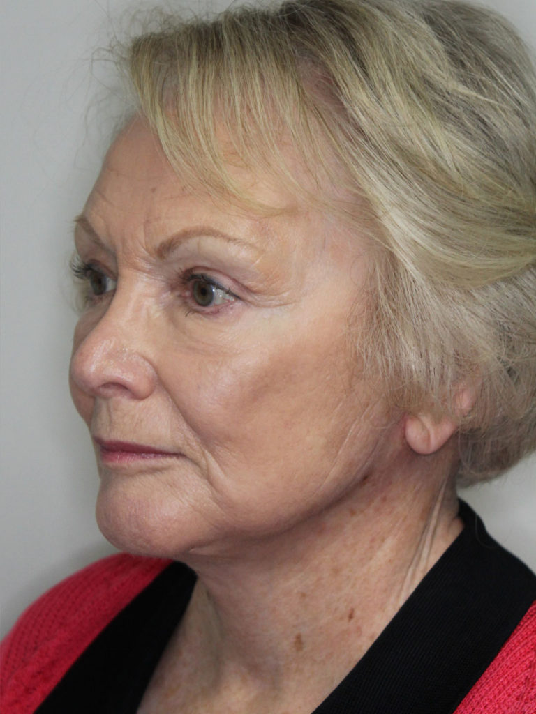 Facelift/Necklift