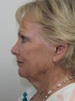 Facelift/Necklift