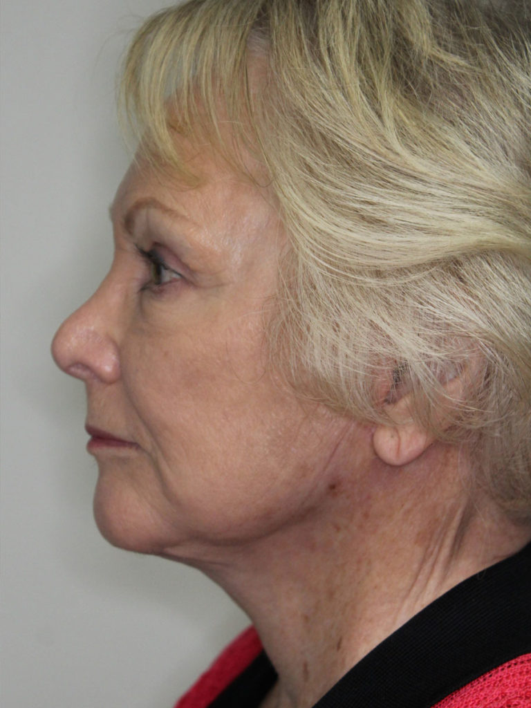 Facelift/Necklift