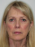 Facelift/Necklift