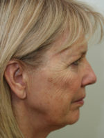 Facelift/Necklift