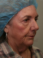 Facelift/Necklift