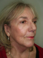 Facelift/Necklift