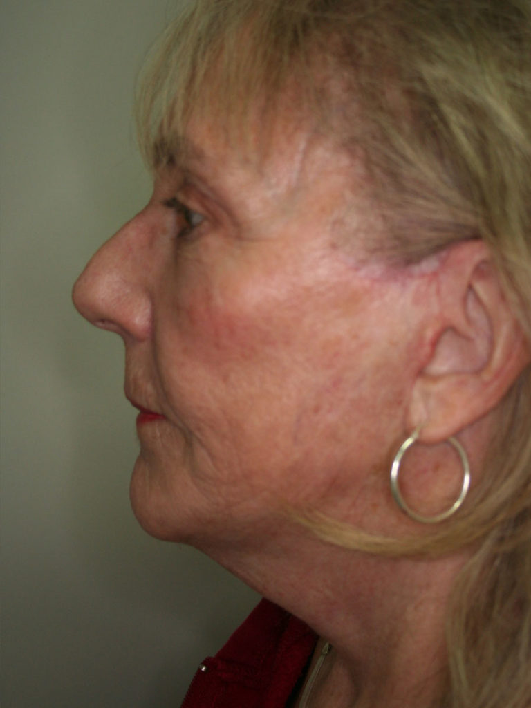 Facelift/Necklift