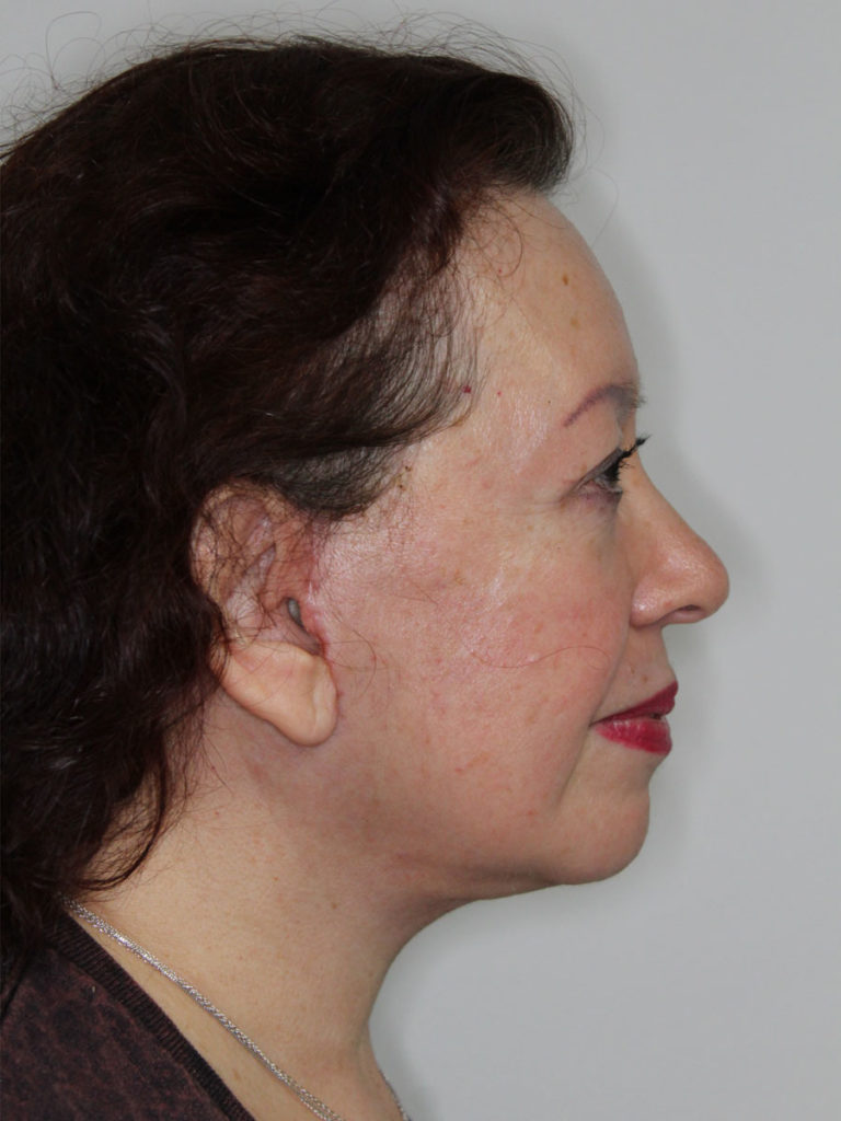 Facelift/Necklift