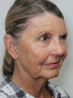 Facelift/Necklift