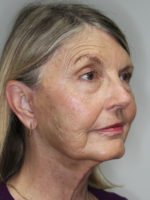 Facelift/Necklift