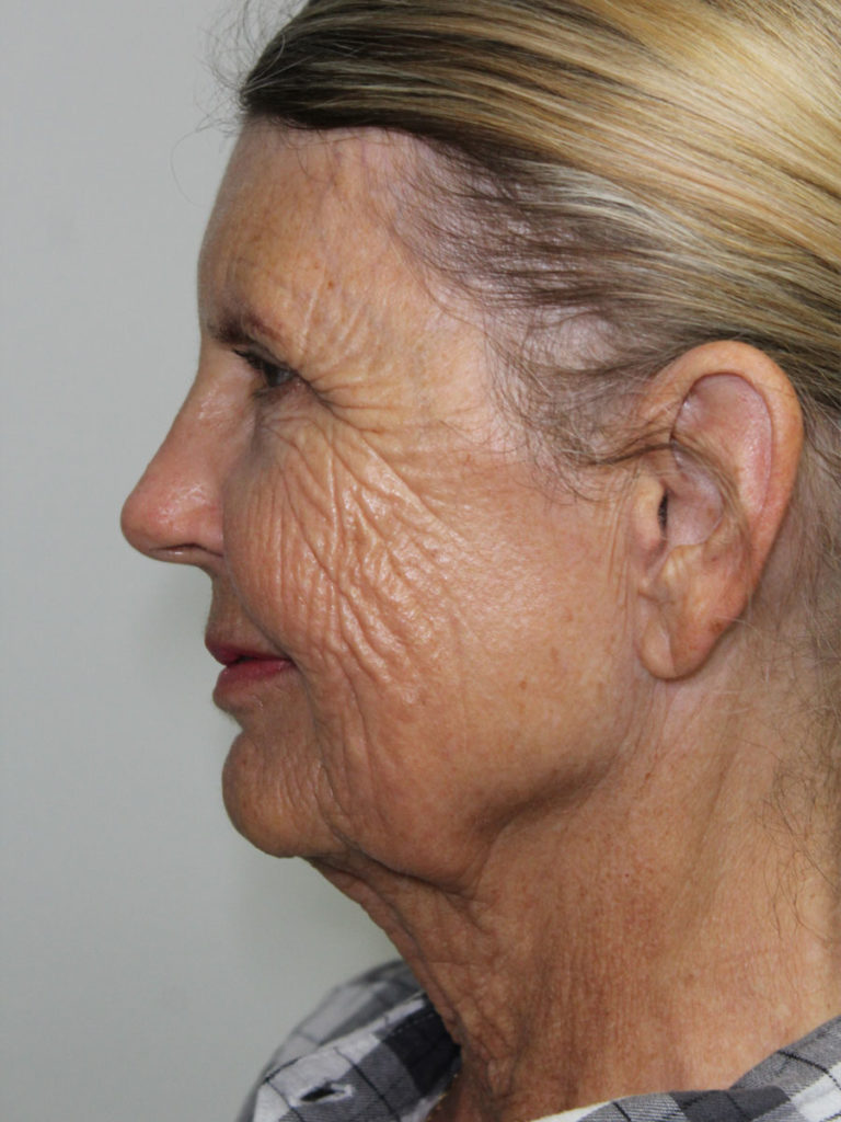 Facelift/Necklift