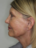 Facelift/Necklift