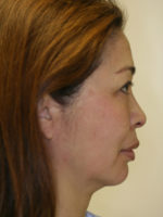 Facelift/Necklift