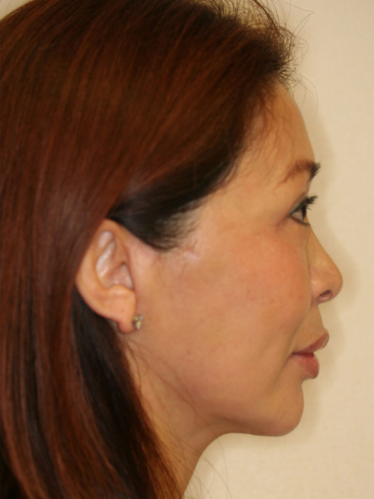 Facelift/Necklift