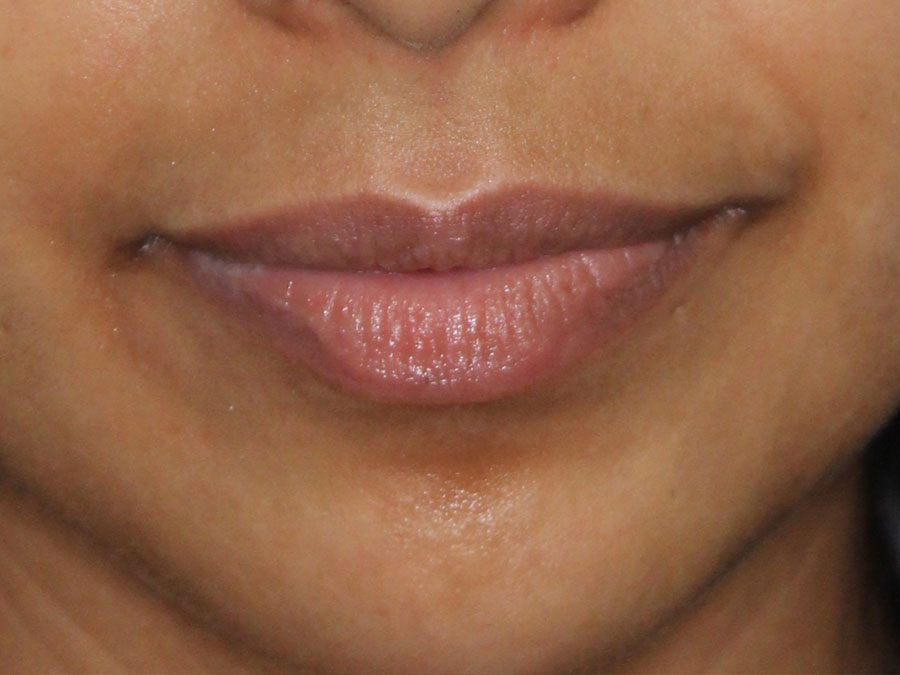 Lip Augmentation