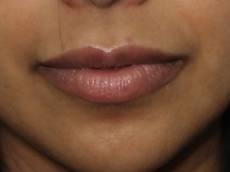 Lip Augmentation