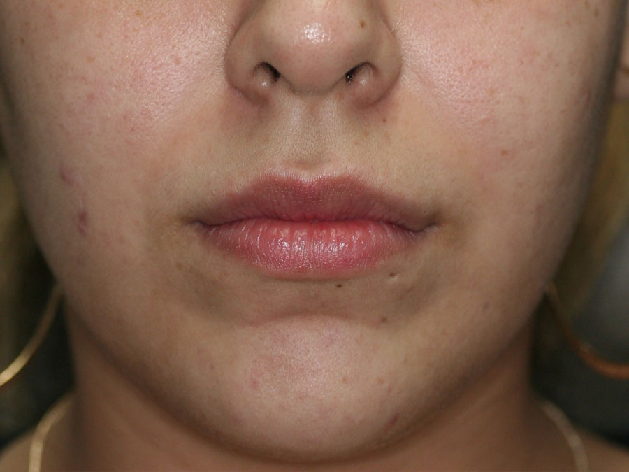 Lip Augmentation