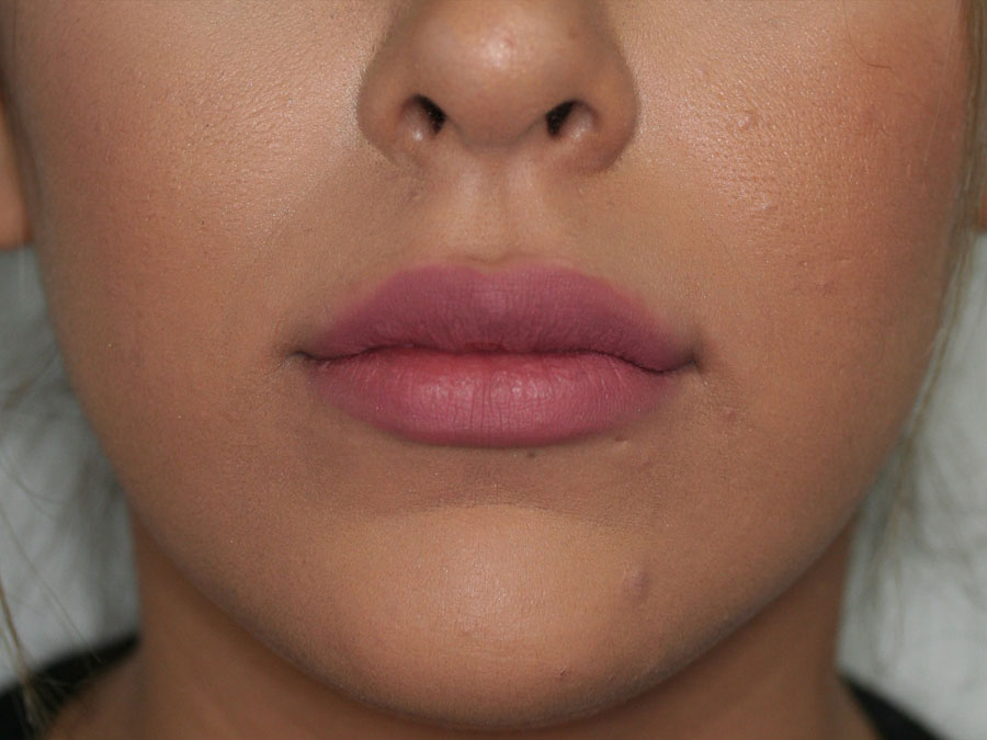 Lip Augmentation