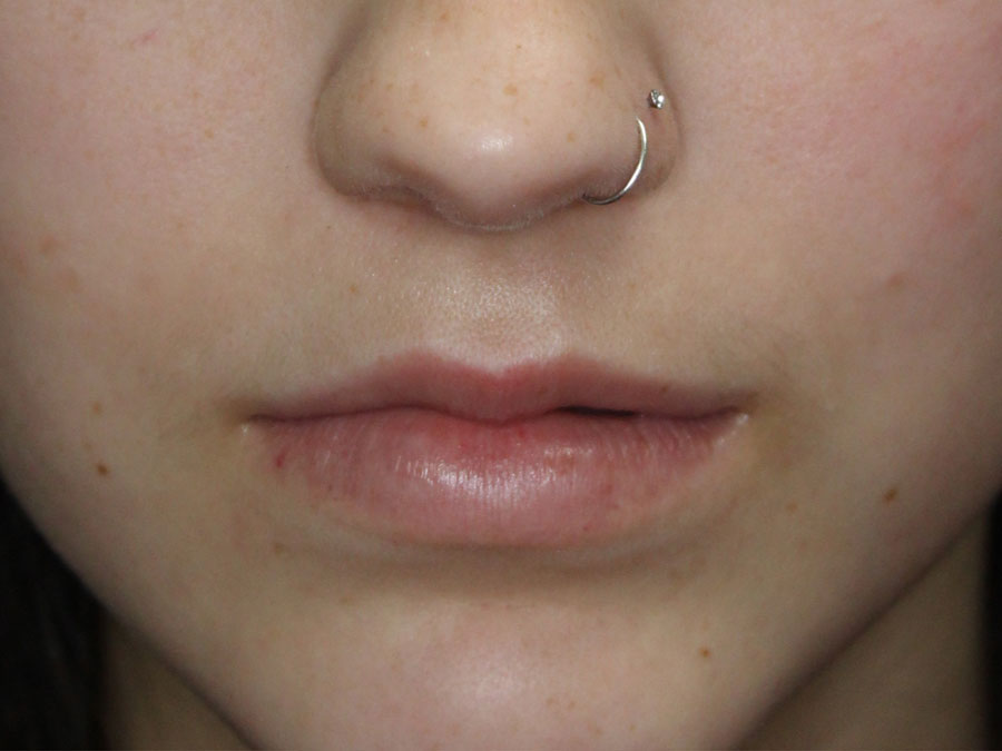 Lip Augmentation