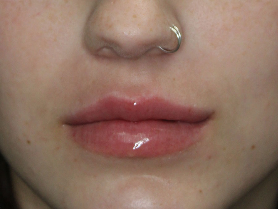 Lip Augmentation