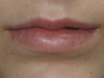 Lip Augmentation