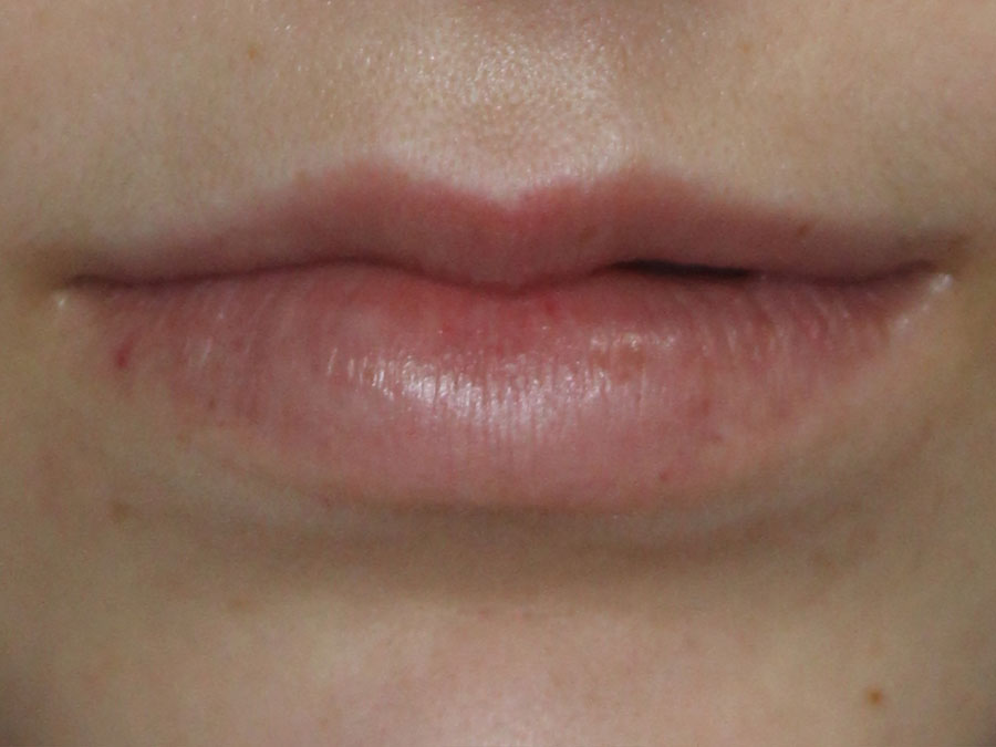 Lip Augmentation