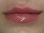 Lip Augmentation