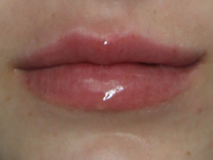 Lip Augmentation