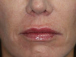 Lip Augmentation