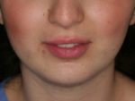 Lip Augmentation