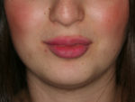 Lip Augmentation