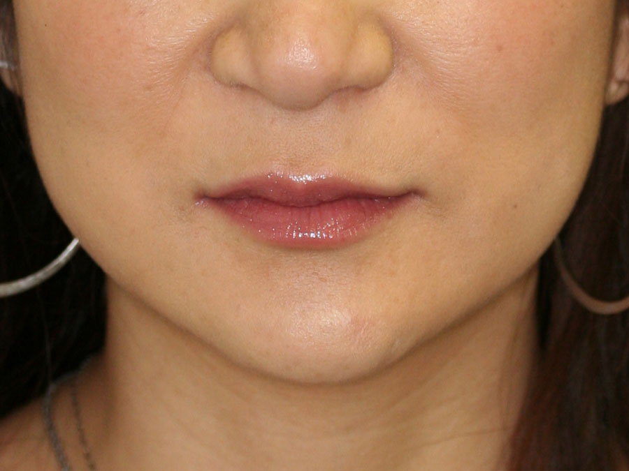 Lip Augmentation