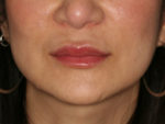 Lip Augmentation