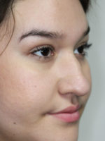 Nonsurgical Rhinoplasty (Nose Reshaping)