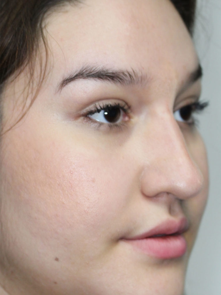 Nonsurgical Rhinoplasty (Nose Reshaping)