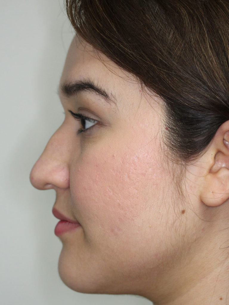 Nonsurgical Rhinoplasty (Nose Reshaping)