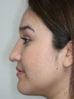 Nonsurgical Rhinoplasty (Nose Reshaping)