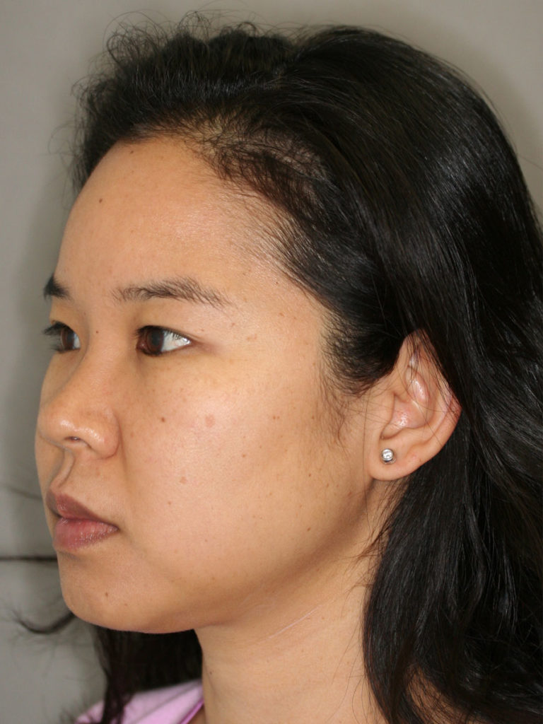 Nonsurgical Rhinoplasty (Nose Reshaping)