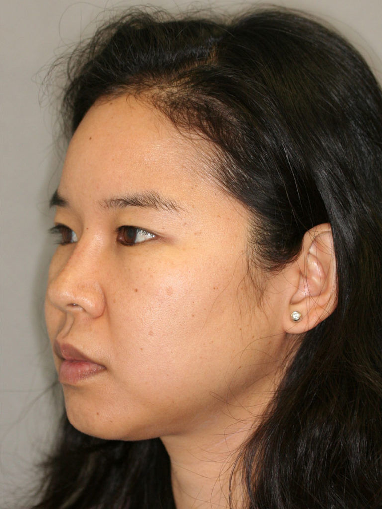 Nonsurgical Rhinoplasty (Nose Reshaping)