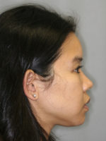 Nonsurgical Rhinoplasty (Nose Reshaping)