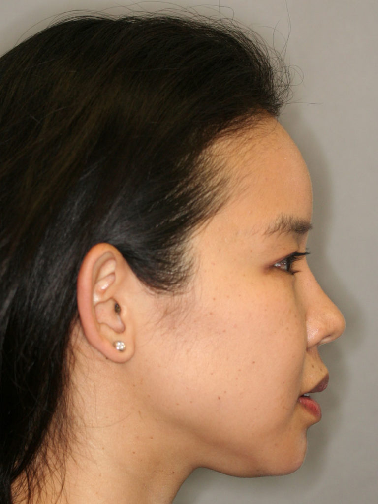 Nonsurgical Rhinoplasty (Nose Reshaping)