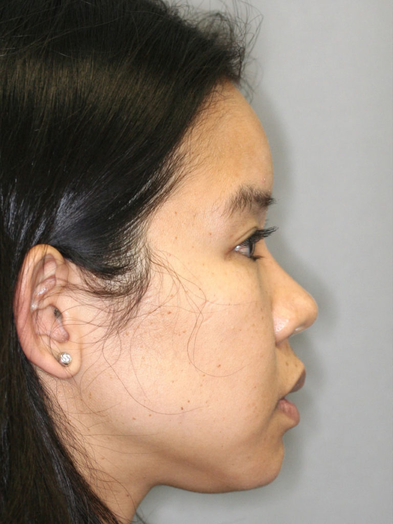 Nonsurgical Rhinoplasty (Nose Reshaping)